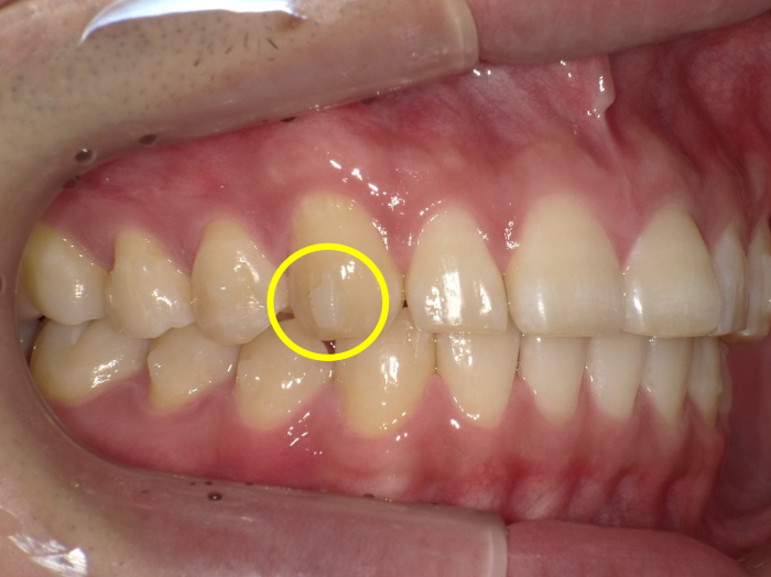 アタッチメントはいつまで？