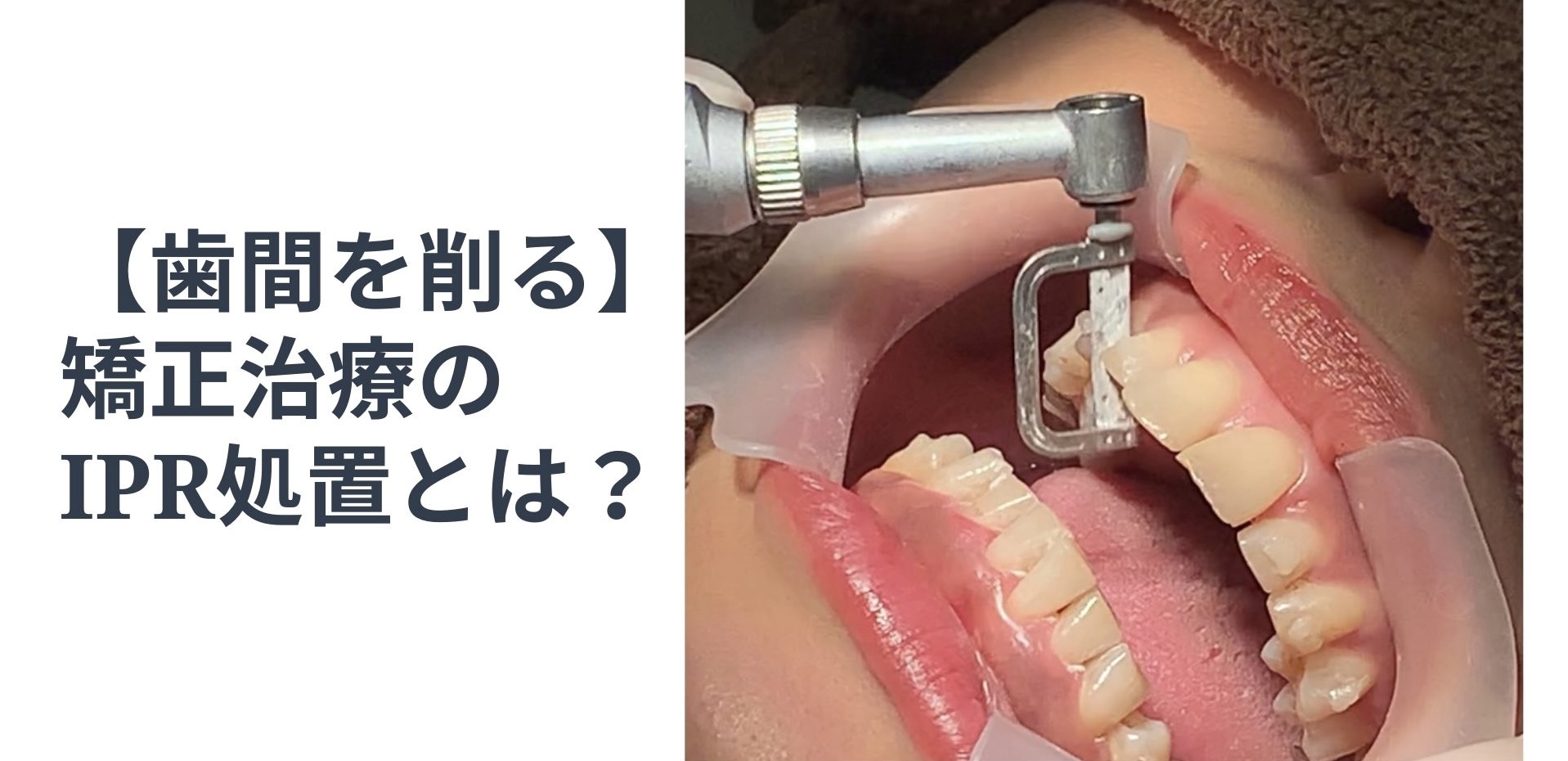 歯間を削る 矯正治療の Ipr アイピーアール とは 大宮駅2分 大宮shin矯正歯科 歯間を削る 矯正治療の Ipr アイピーアール とは 大宮駅2分 大宮shin矯正歯科