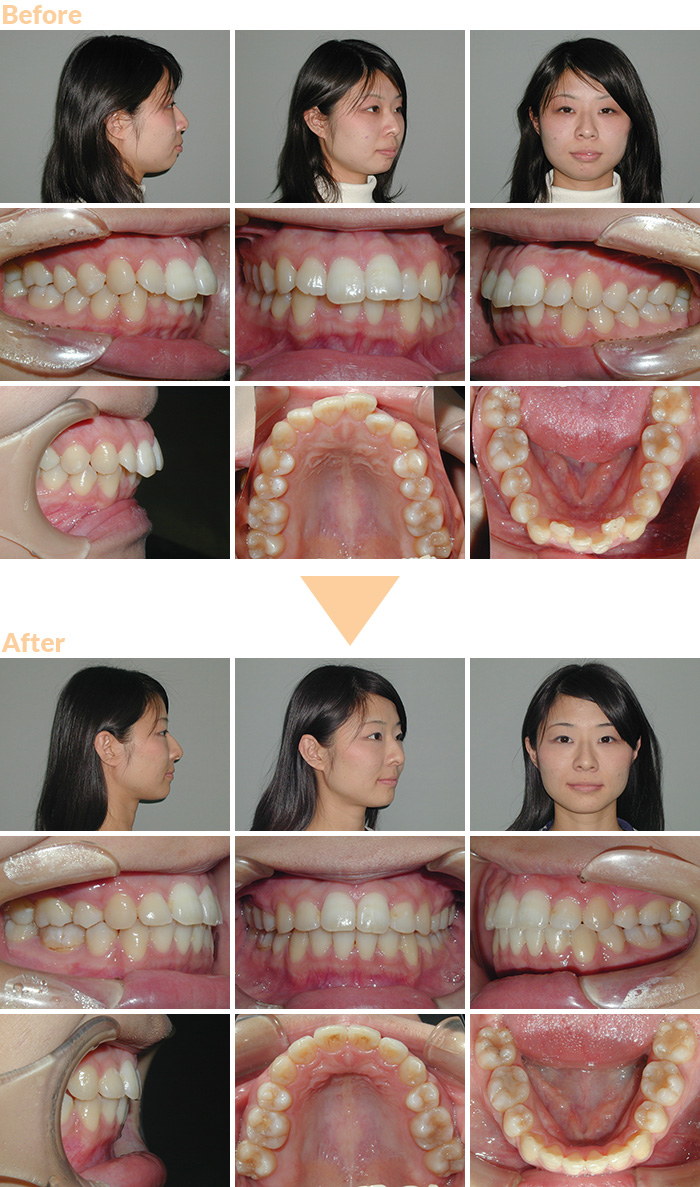 上下顎前突 20歳 女性 治療期間：2年6ヶ月【大宮駅2分】大宮SHIN矯正歯科