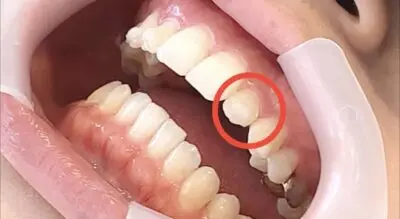 アタッチメント　外れた