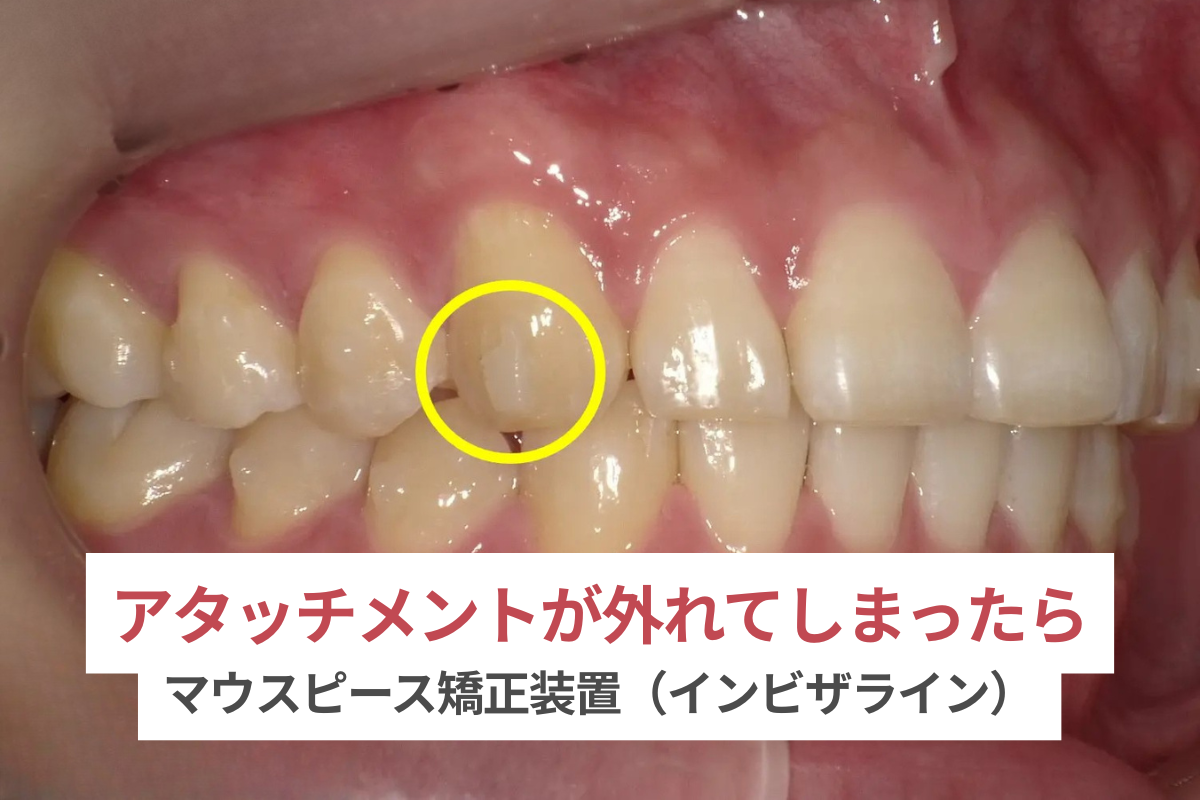 アタッチメント 外れた インビザライン