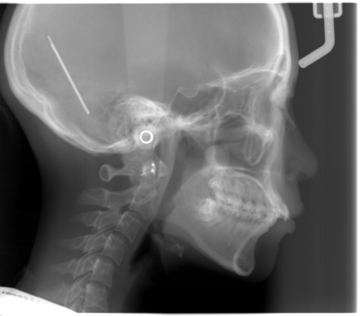 矯正、セファロ