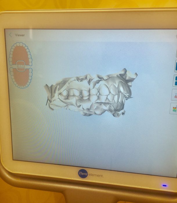 口腔内スキャン画像