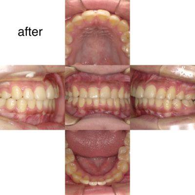抜歯しないほうがよい八重歯 大宮駅2分 大宮shin矯正歯科