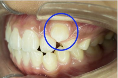 抜歯しないほうがよい八重歯 大宮駅2分 大宮shin矯正歯科