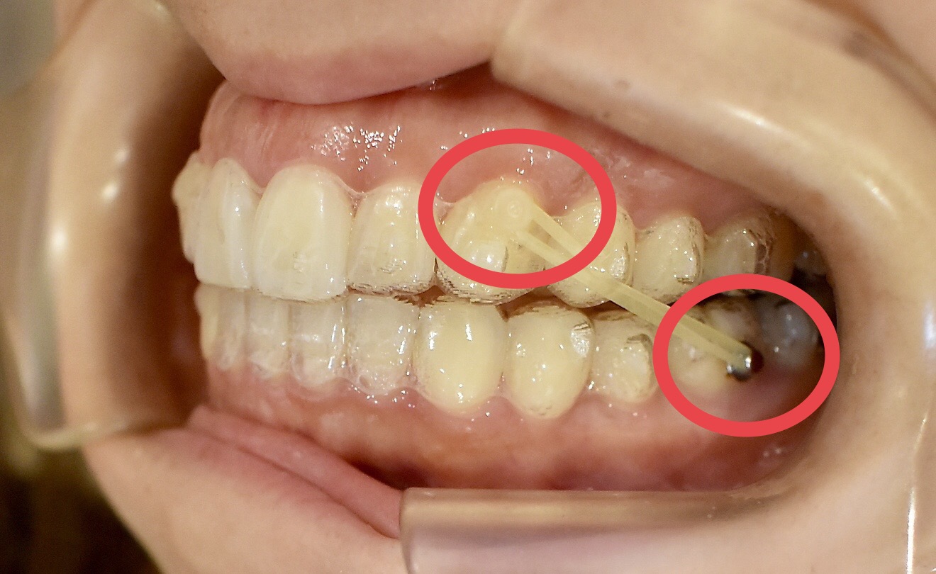 ビッグ割引 歯科矯正 顎間ゴム ゴムかけ 歯並び エラスティック ワイヤー インビザライン