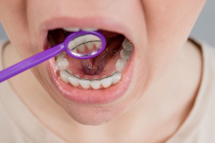 リテーナの種類 fixリテーナー 目立たない