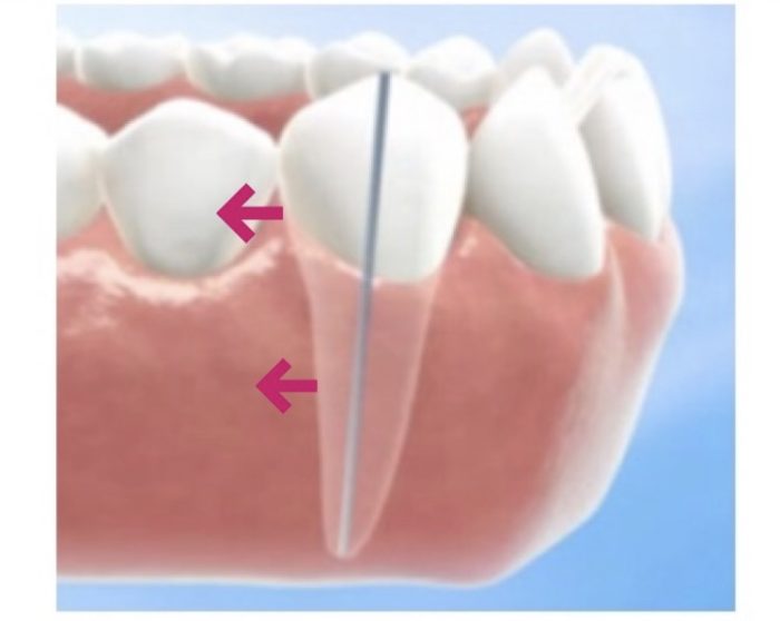 歯列矯正　水平移動