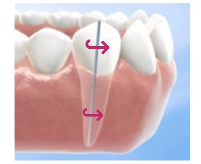 歯列矯正　捻転