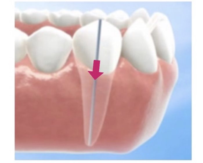 歯列矯正　圧下