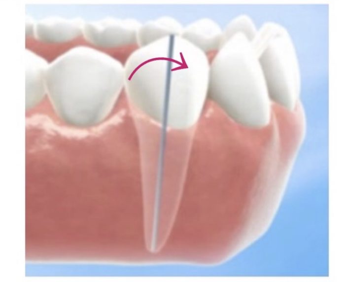 歯列矯正　傾斜