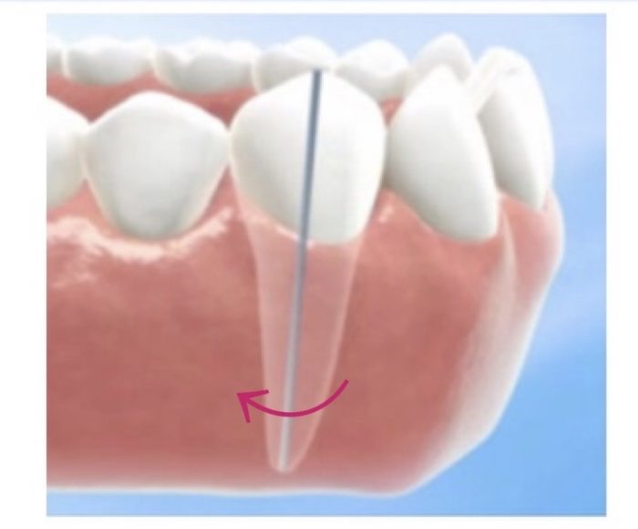 歯列矯正　歯根移動