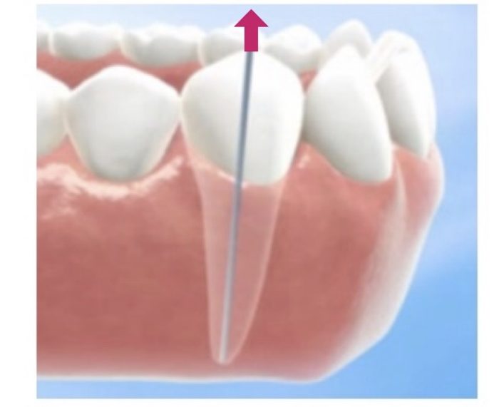 歯列矯正　挺出