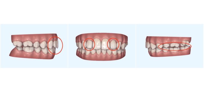出っ歯　インビザライン　シミュレーション