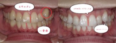 マウスピース型矯正装置 インビザライン で八重歯が浮く時の対処法 大宮駅2分 大宮shin矯正歯科
