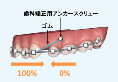アンカースクリューを併用したワイヤー矯正治療の歯の移動様式