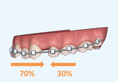 通常のワイヤー矯正における歯の移動様式