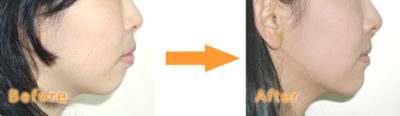 矯正用アンカースクリューを併用したワイヤー矯正治療前後の症例写真、横顔の変化