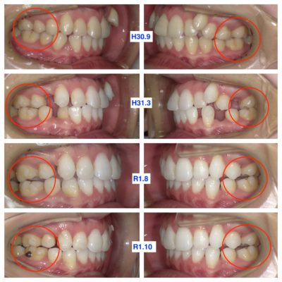 奥歯が浮いて作り直し マウスピース 型矯正装置 インビザライン 大宮駅2分 大宮shin矯正歯科