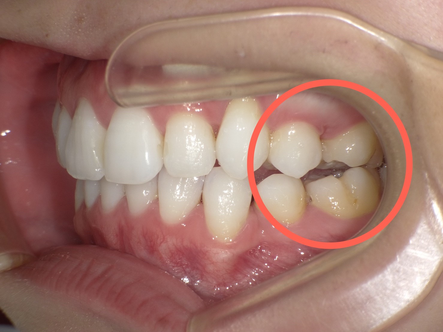 奥歯が浮いて作り直し…【マウスピース 型矯正装置（インビザライン ）】【大宮駅2分】大宮SHIN矯正歯科