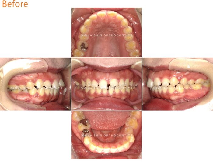 正中離開 マウスピース矯正 インビザライン