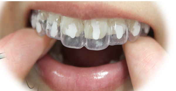 矯正治療中のホームホワイトニング】歯並びを治しながら歯を白くする