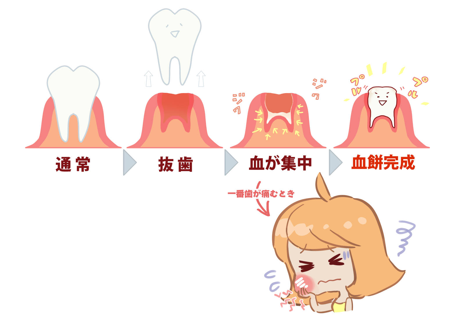 抜歯後 血餅 取れた – 抜歯後の血餅はがれやすい _ 抜歯の傷口を守る血餅 とは？ドライソケット予防の基礎知識 – POIWR