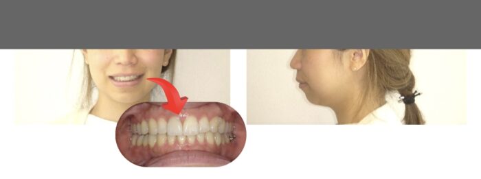 歯並びはいいのに口ゴボ