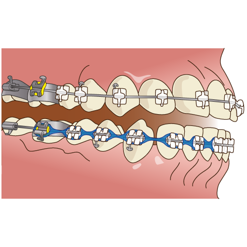 パワーチェーン 矯正