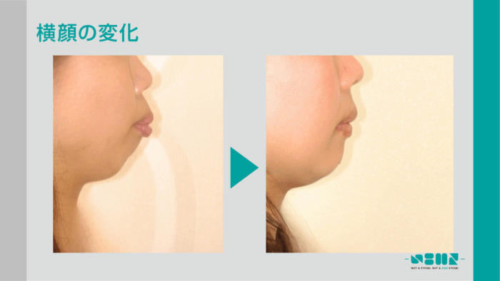 出っ歯、横顔、変化