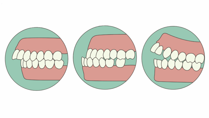 出っ歯、受け口、開咬のイラスト
