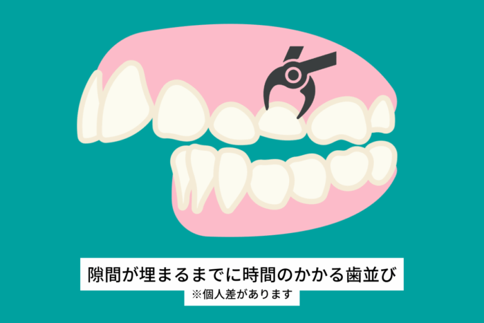 抜歯後の隙間が閉じるまでに時間がかかる歯並び