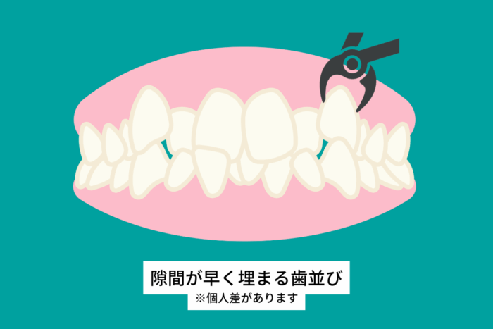 抜歯後の隙間が早く埋まる歯並び