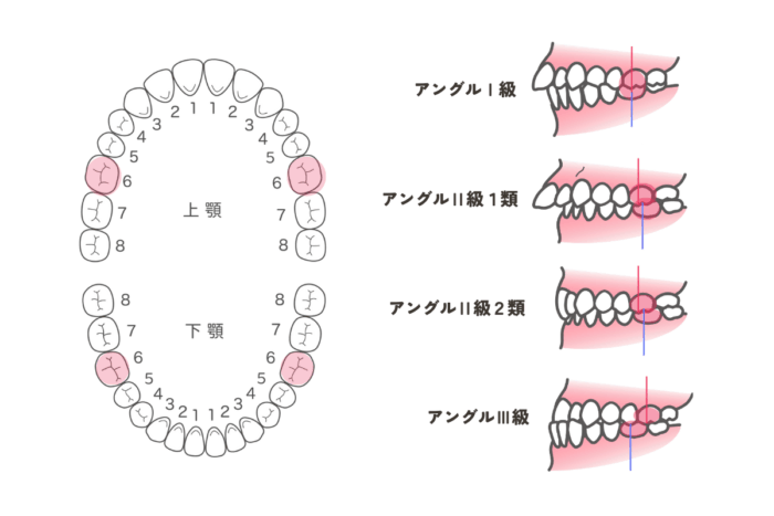 アングルの分類とは
