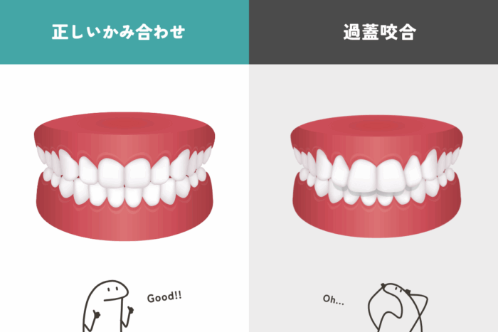 過蓋咬合ってどんな歯並び？