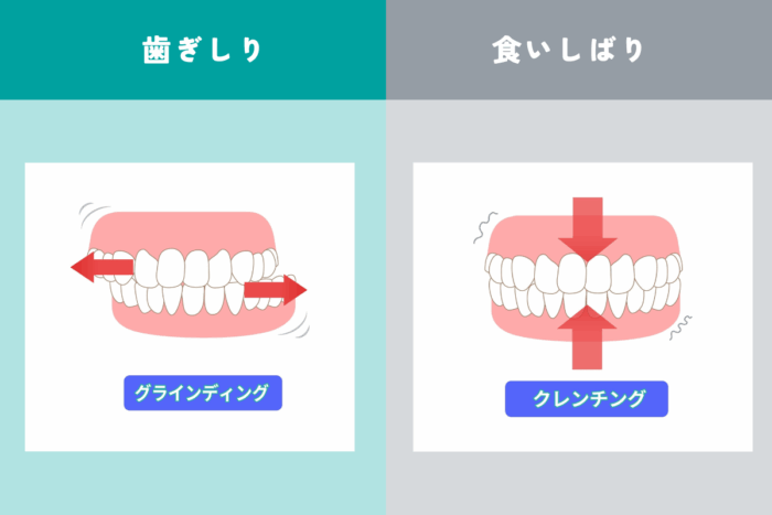 歯ぎしりと食いしばりの違い