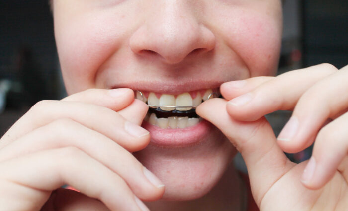 矯正　再治療　リテーナーの装着不足