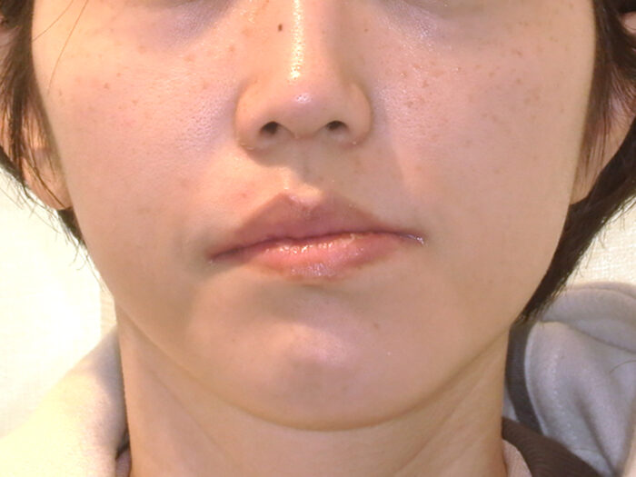 顔の歪み　歯列矯正