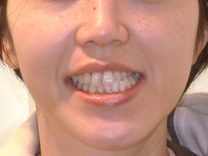 反対咬合　口元