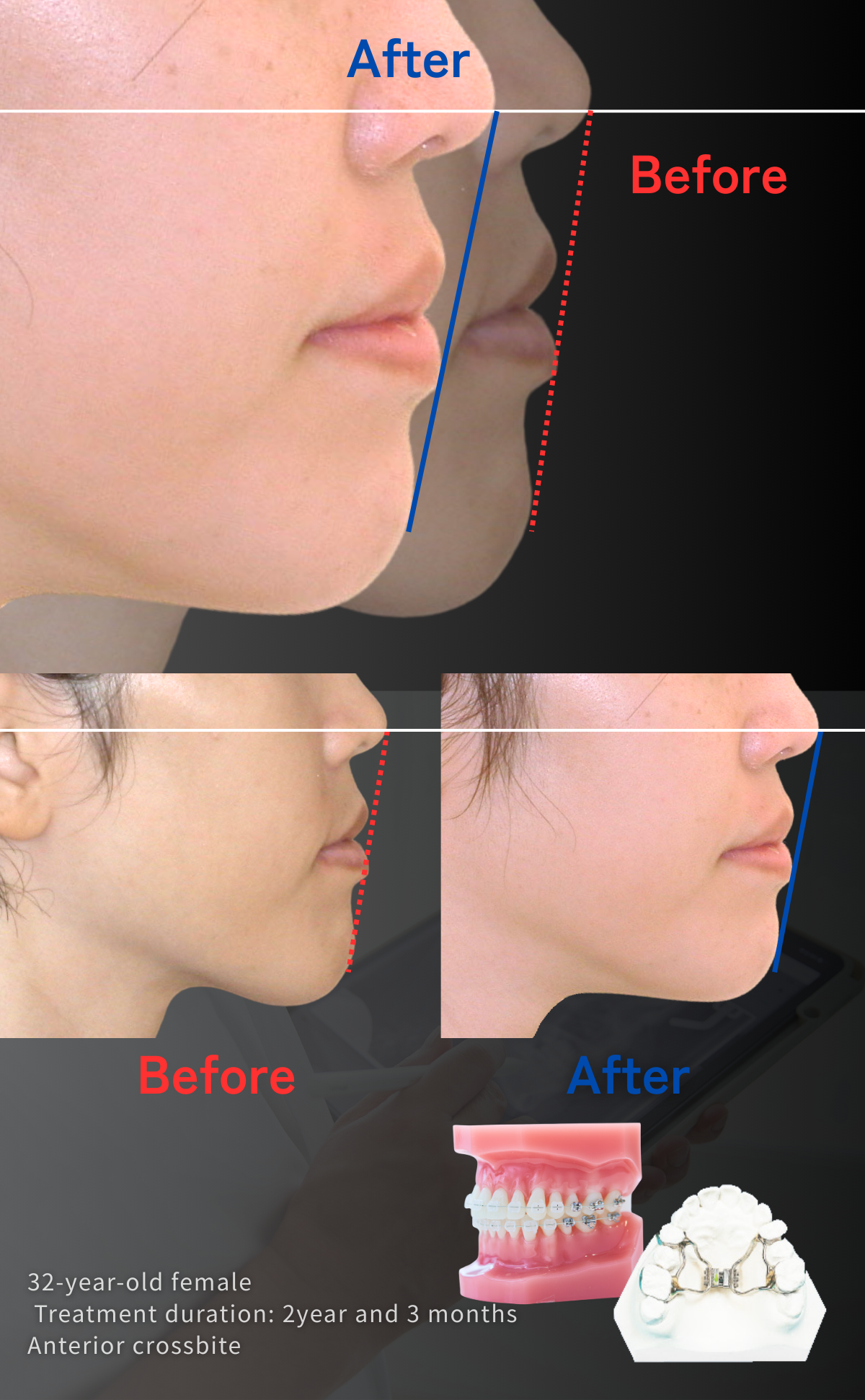 反対咬合　横顔の変化