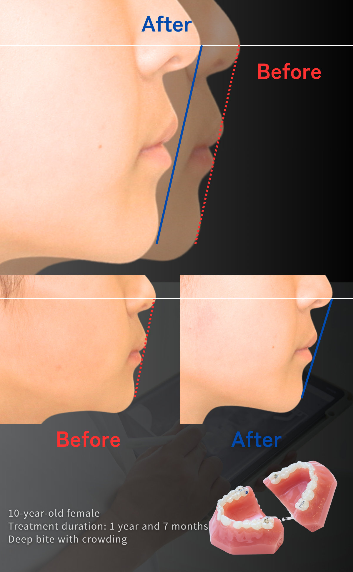 子ども、歯列矯正、横顔の変化