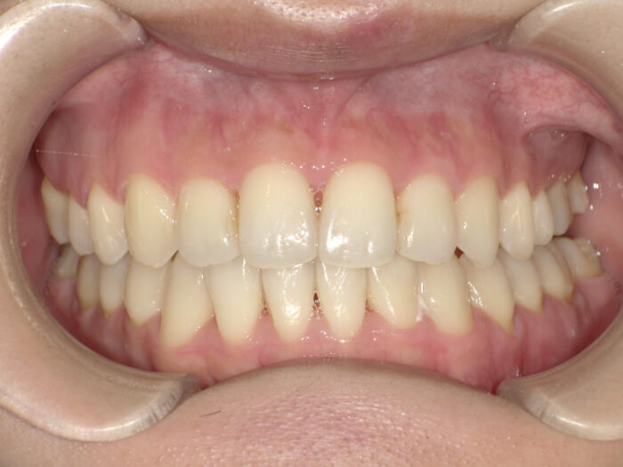 反対咬合　矯正治療後