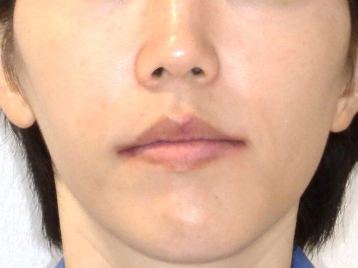 顔の歪み　歯列矯正後　改善