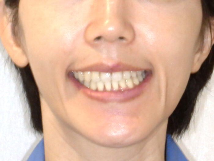 反対咬合　矯正治療後　口元