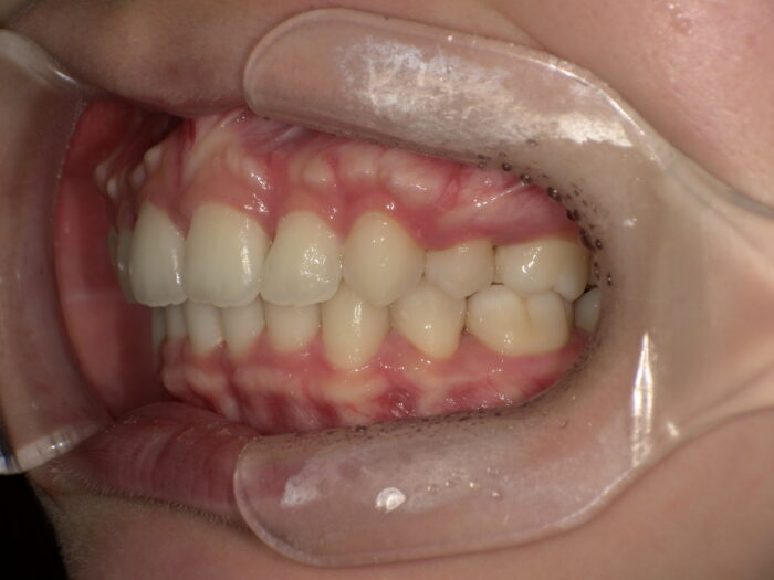 口ゴボ、鋏状咬合の改善