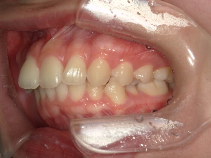 口ゴボの改善、鋏状咬合
