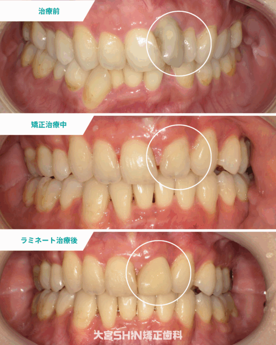 矯正治療後の前歯の形・色を整えたい方へ｜ラミネートベニア